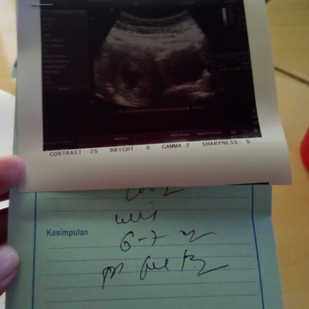 bun tadi aku d USG ktnya aku masuk khmilan 6 minggu da posisi khmilan aku blm aman bun krna aku sering ngflek d d sruh kontrol lgi USG 2 minggu mudah2an nanti minggu kdpnnya kandungn aku baik2 saja amiiin adakah bunda ad yg sama kaya hamil aku bun???