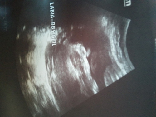 Ultrasound at 27 weeks.