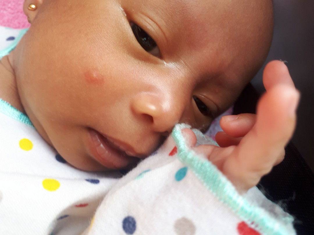 bintik di pipi dan kepala