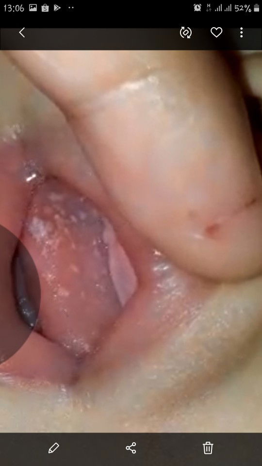 dilidah ada putih putih