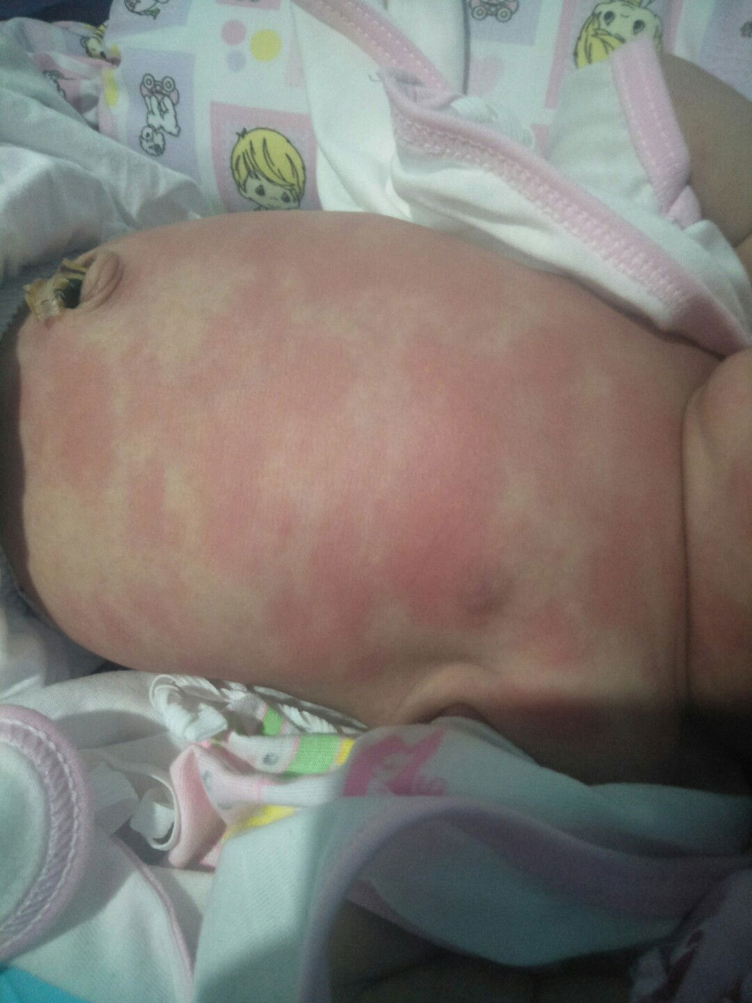 1 day old baby and rashes