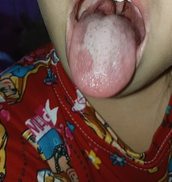 tonsillitis napo ba ito sa bata? ano ba dapat igamot or home remedy sa batang may tonsillitis? ..