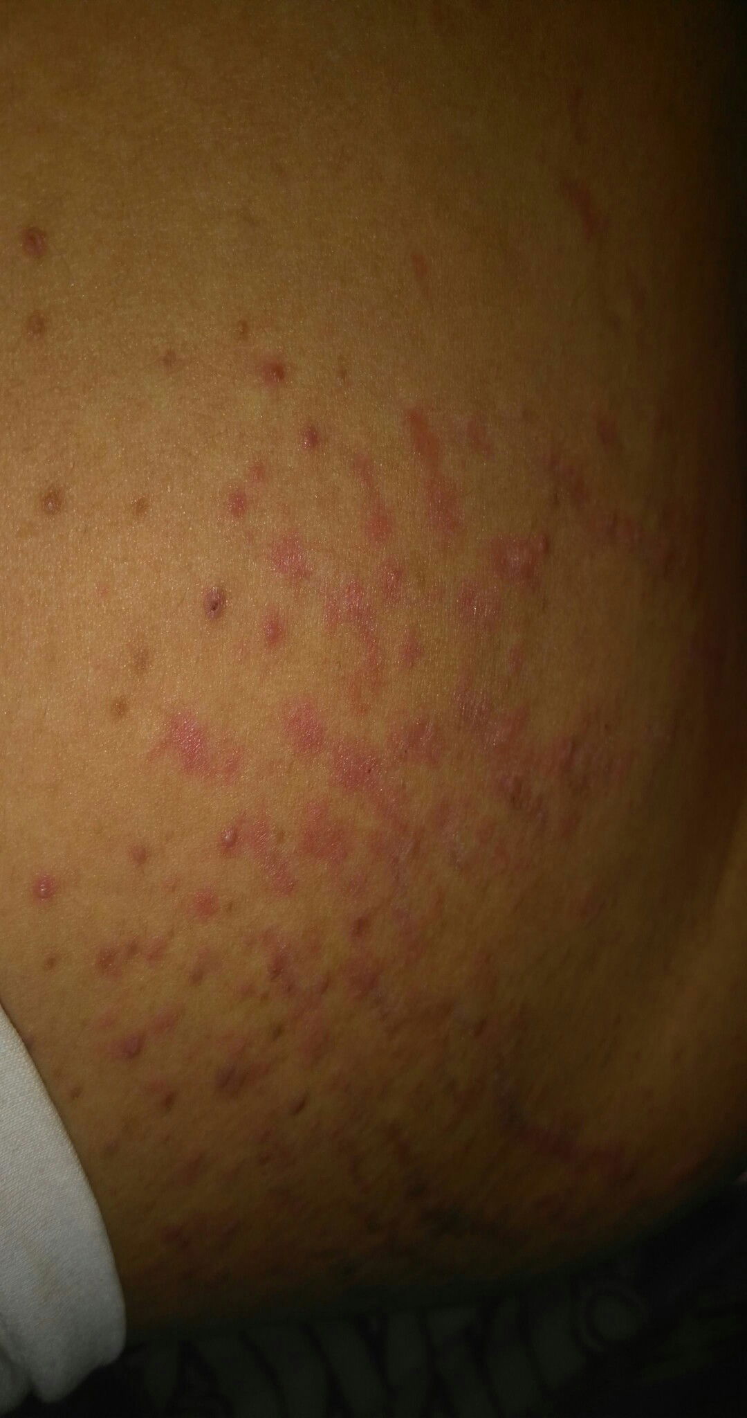 gatal di stretchmark dan bentol2 seperti alergi