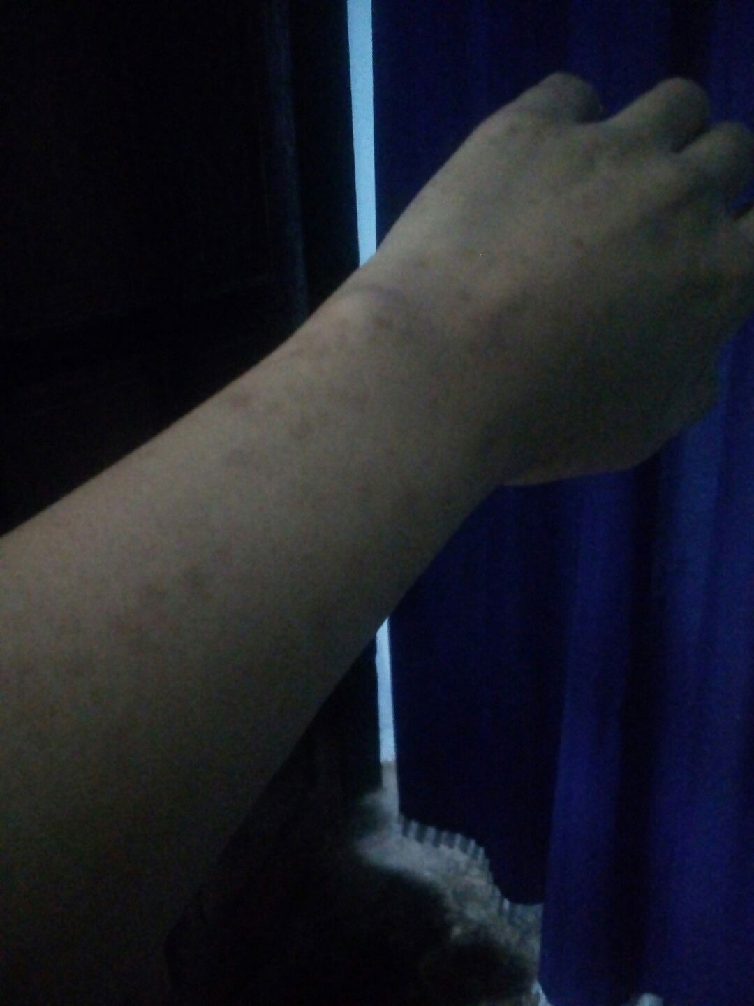 bekas gigitan nyamuk