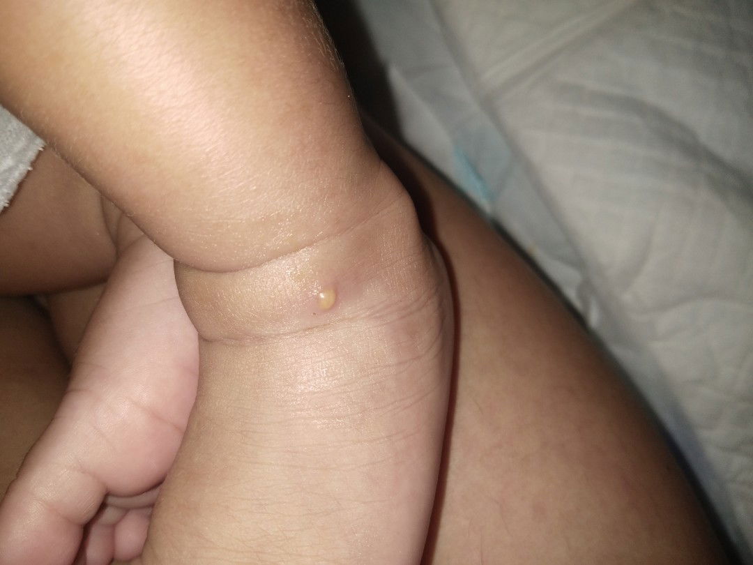 น้องมีตุ่มใสๆแข็งขึ้นตรงข้อเท้า