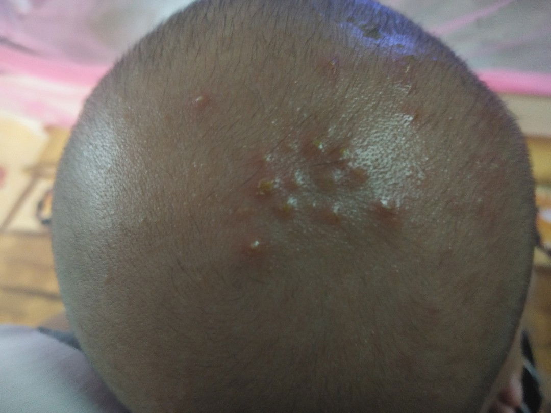 หัวน้องมีอาการร้อนๆร้อนแค่หัวตัวไม่ร้อนคะ