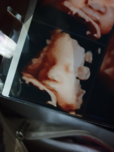 Breech Baby