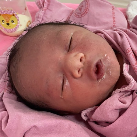 รอยช้ำบนแก้ม