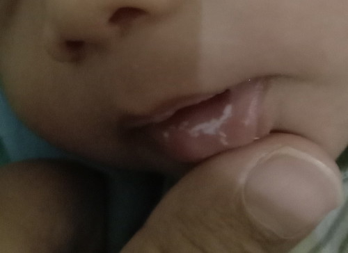 Bibir bayi seperti melepuh