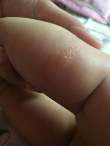 Allergy or Insect bite?