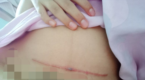 แบบนี้เรียกแผลปริมั้ยคะ