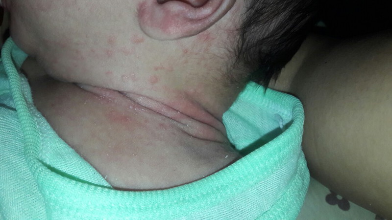 Rashes? Sa tingin nyo po rashes po ito diba? Ano po pwedeng