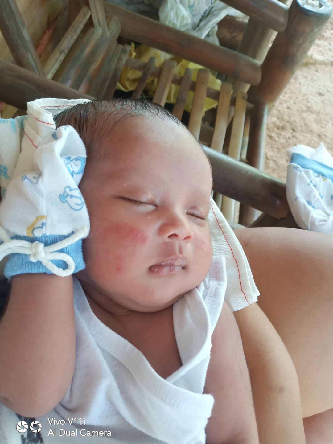 Skin Rashes sa Face ni Lo ko..