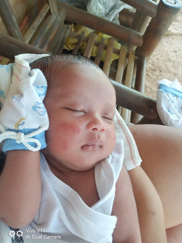 Skin Rashes sa Face ni Lo ko..