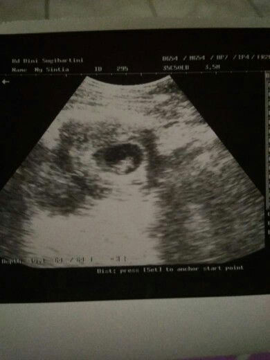 Bertanya seputar awal kehamilan