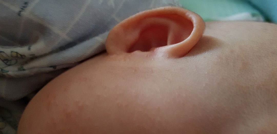 ผื่นบนหน้า