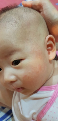 อาการแบบนี้เป็นผื่นหรือภูมิแพ้คะ