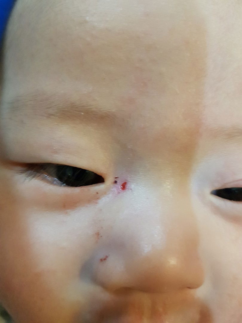 ลูกมีแผลที่หัวตาแบบนี้ติดแผลด้วยอะไรดีคะ