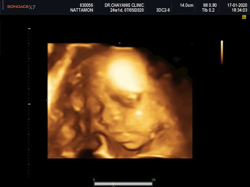 24+1wk