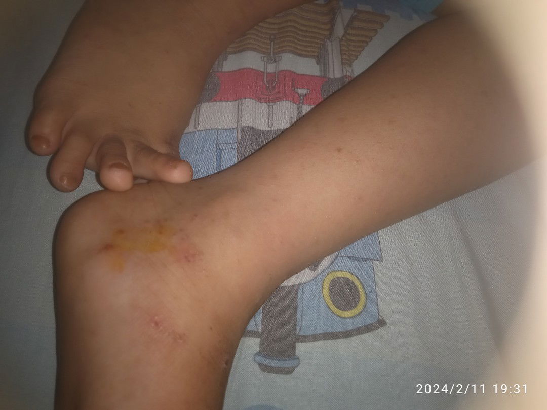 Gatal2 dan ada sebagian muncul nanah