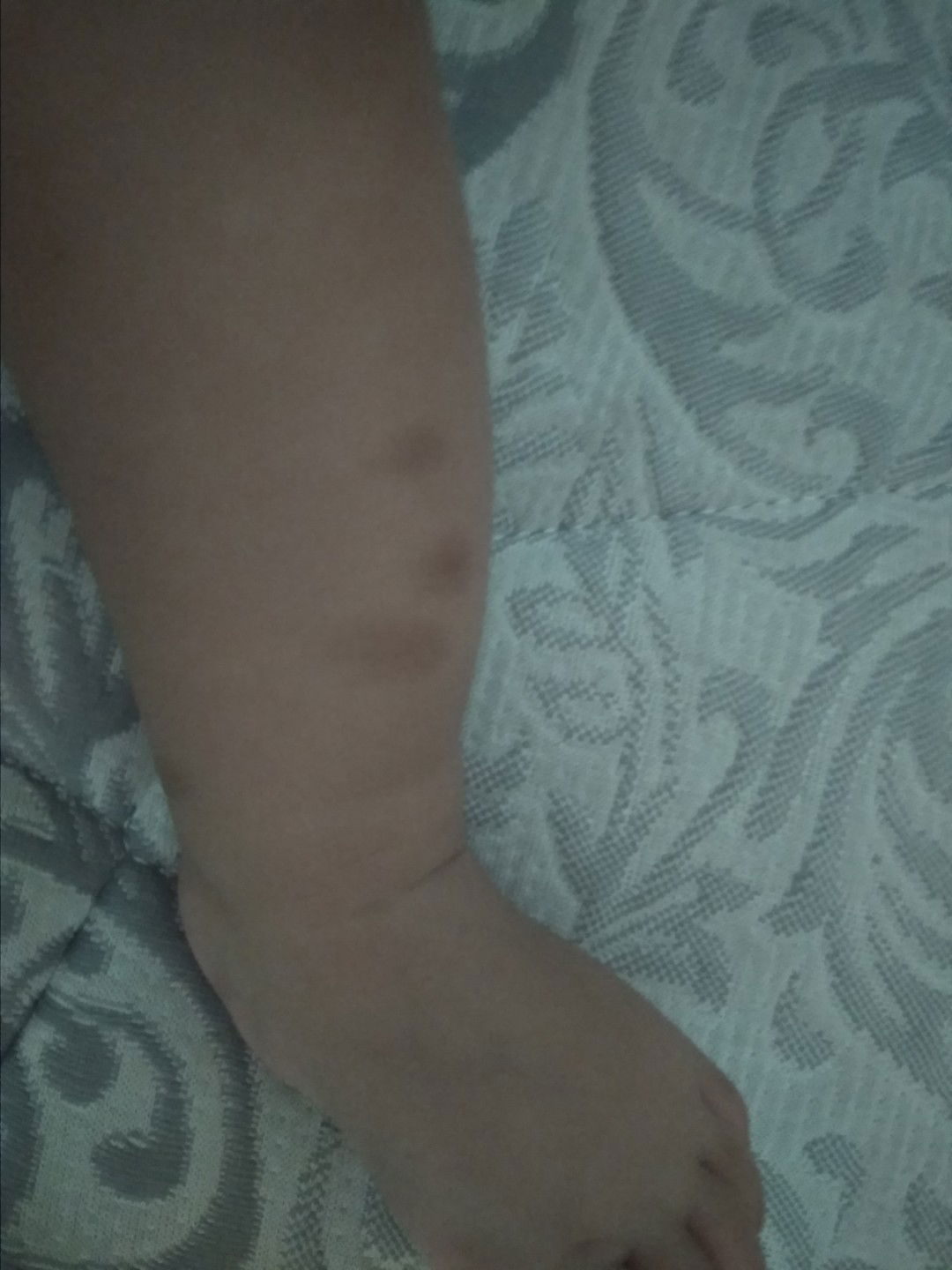 bekas gigitan nyamuk