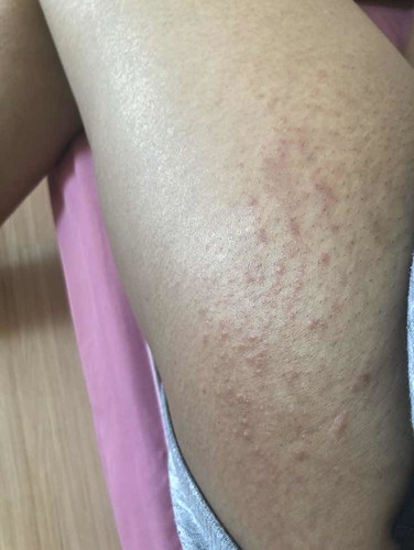 ผื่นขึ้น