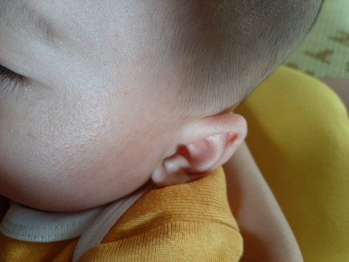ผื่นขึ้นที่หน้า