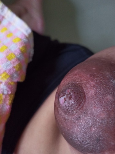 เจ็บหัวนม