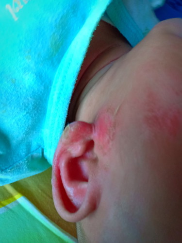 แผลเด็ก