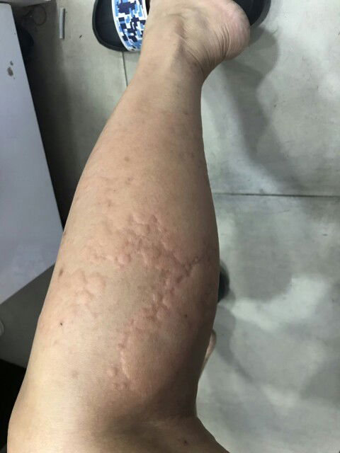 Bệnh nổi ban ngứa