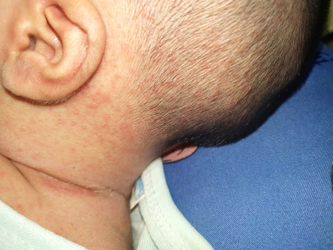 bé bị nổi mụn