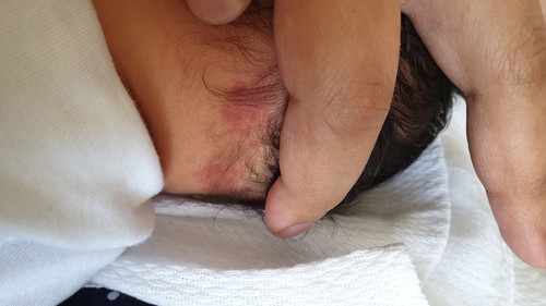 birthmark or rashes?