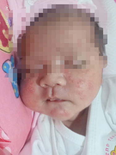 rashes