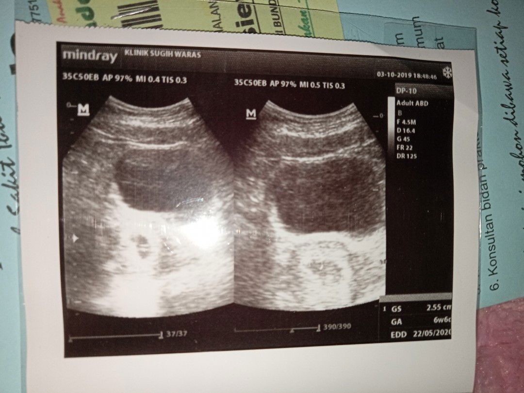 usia janin dri hasil usg
