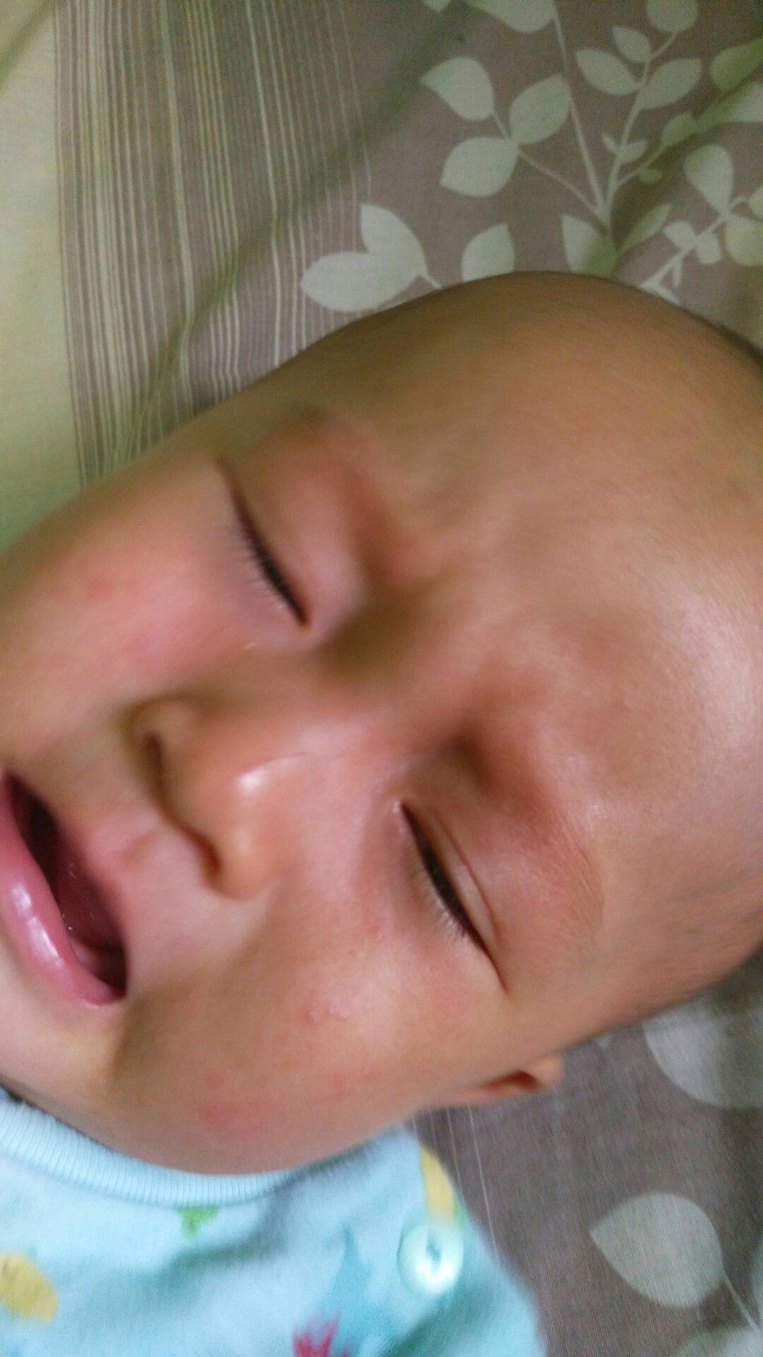 alergi atau biang keringet bun?