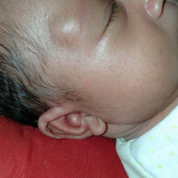 benjolan dikening anakku