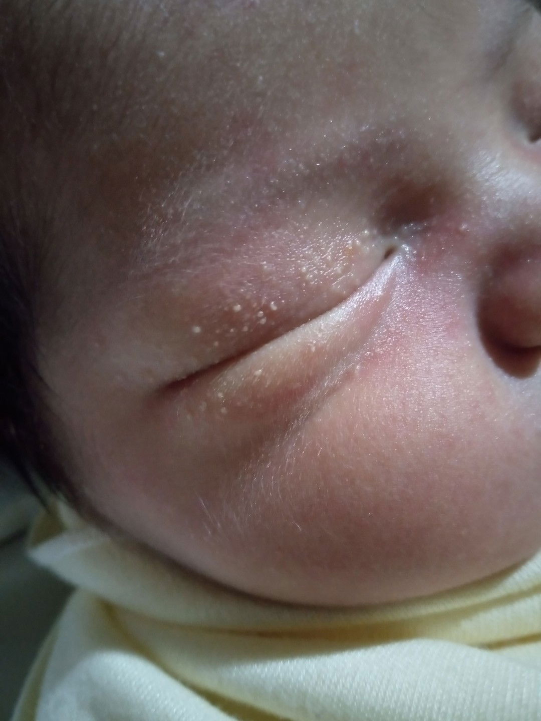 Bintik Putih Pada Bayi Newborn