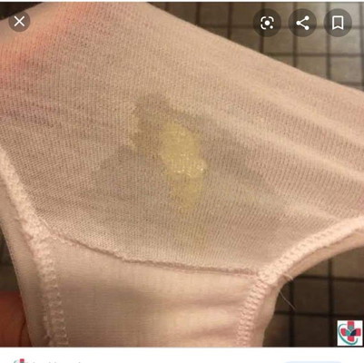 vaginal discharge