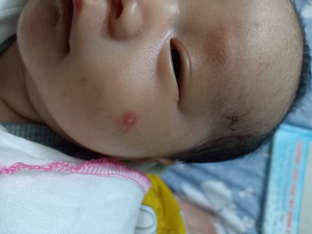 Bé nhà mình mọc mụn xong sưng thê này phải làm sao