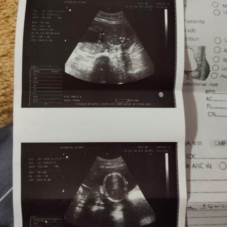 24สัปดาห์แล้วน้องยังไม่ให้ดูเลยว่าหญิงหรือชาย