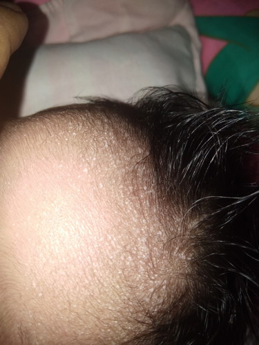 Rashes