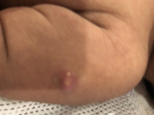 Bekas jaruman vaksin