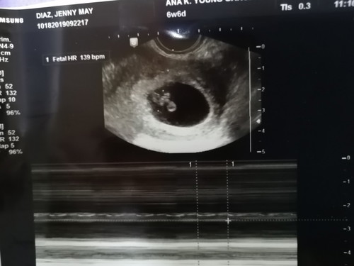 Anembryonic Pregnancy