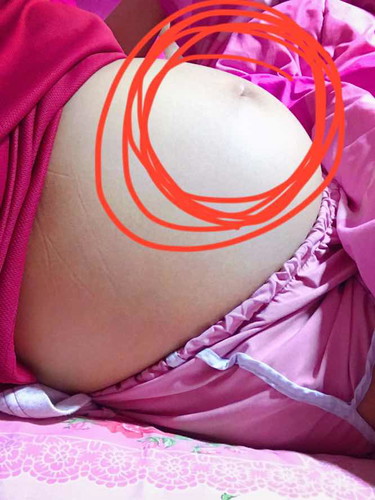 เจ็บผิวรอบๆสะดือ