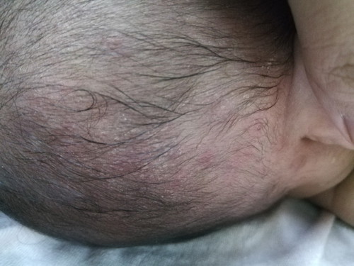 Jerawat/Cradle Cap