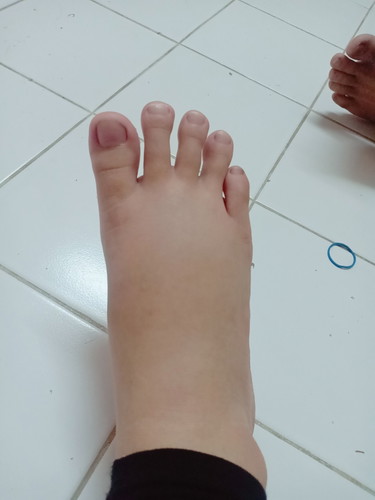 เท้าบวม
