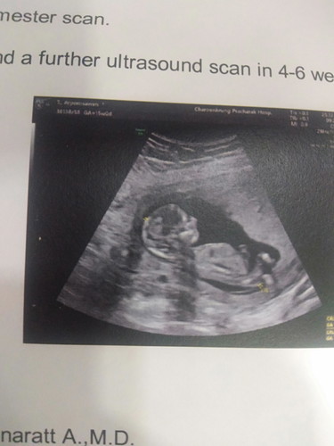 อัลตร้าซาวด์