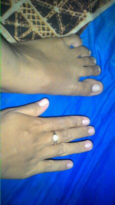 Usia hamil 16W5D kaki&tangan bengkak