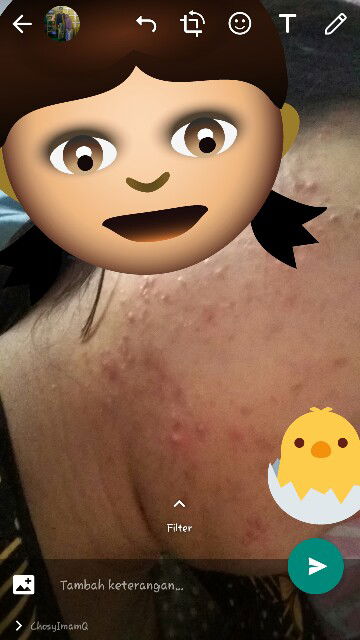 bisa hilang sendiri g stelah melahirkan?