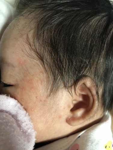 Newborn Rashes